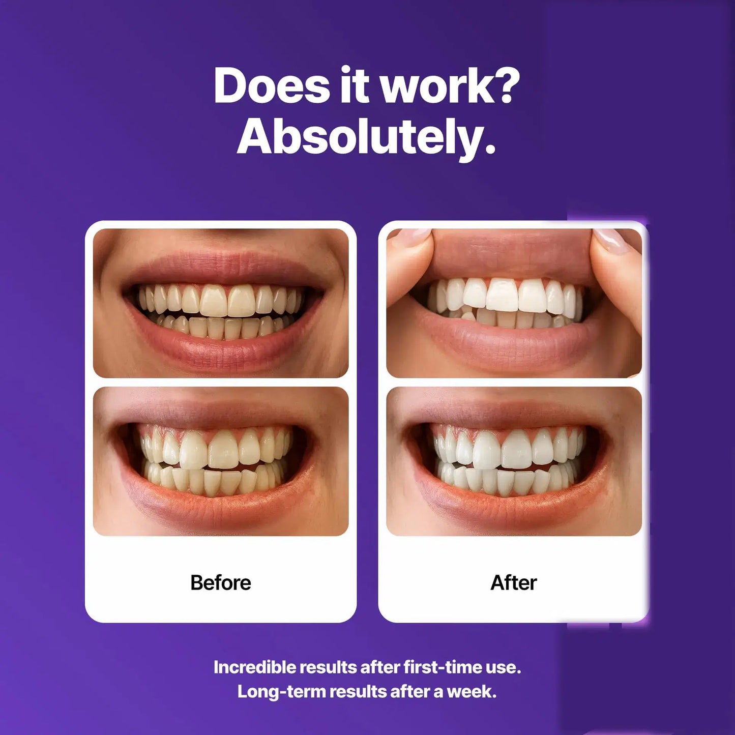 Teeth Whitening Strips for a Brighter Smile