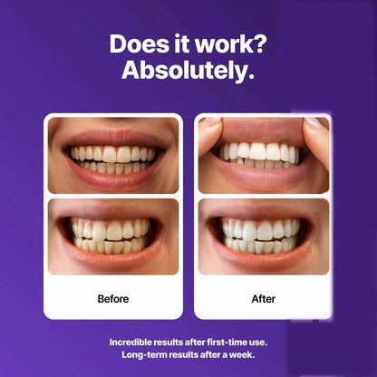 Teeth Whitening Strips for a Brighter Smile